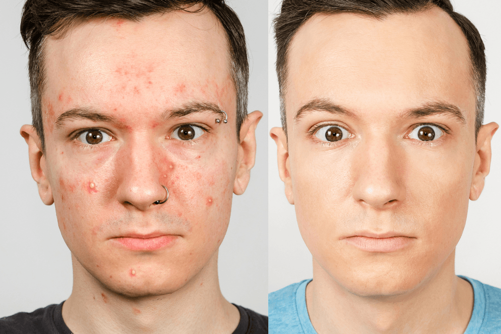 Quels sont les causes de acné et quels sont les traitements efficaces ?