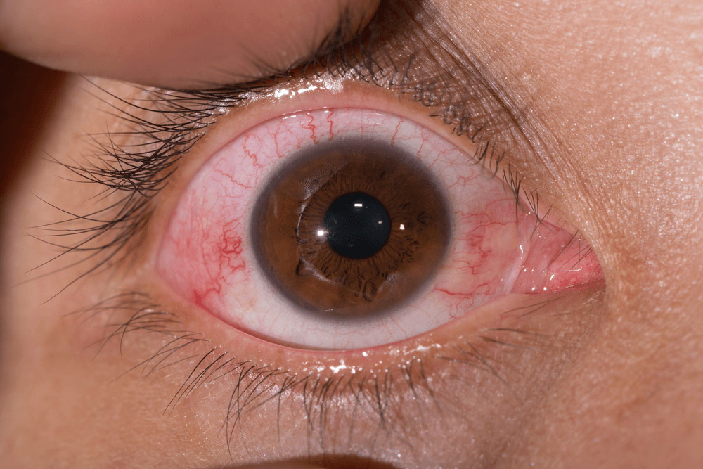 maladie de Lyme symptômes yeux