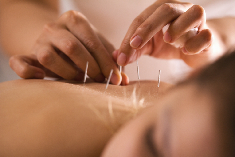 acupuncture et fibromyalgie