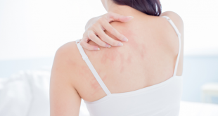 allergie de contact traitements et prévention