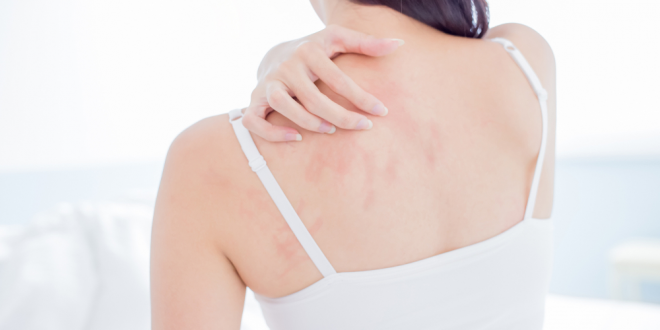 allergie de contact traitements et prévention