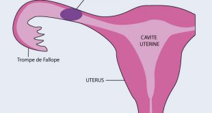 grossesse extra-utérine