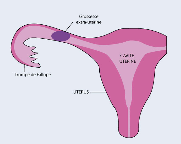 grossesse extra-utérine