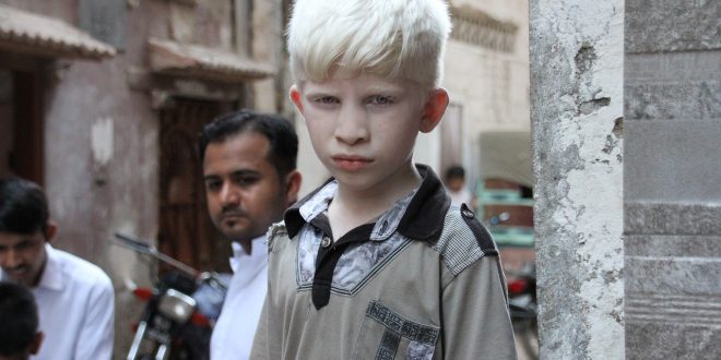 albinisme