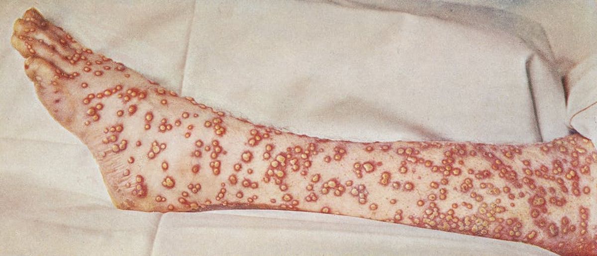 symptômes variole