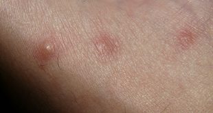 signes d'allergies aux piqûres des insectes