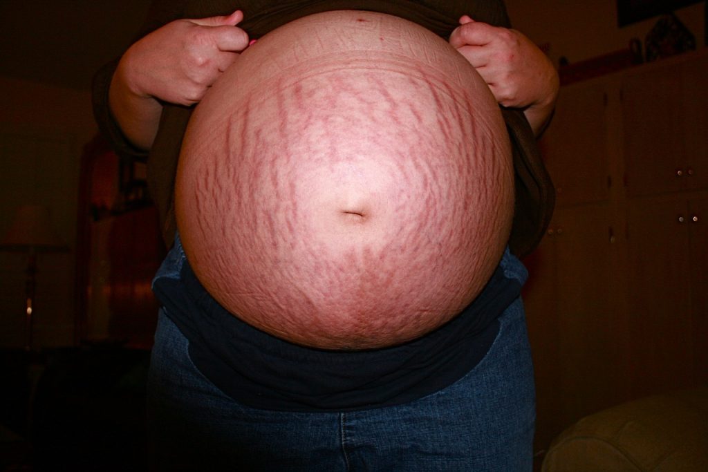 éviter les vergetures pendant la grossesse