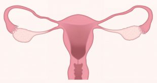 cancer du col de l’utérus