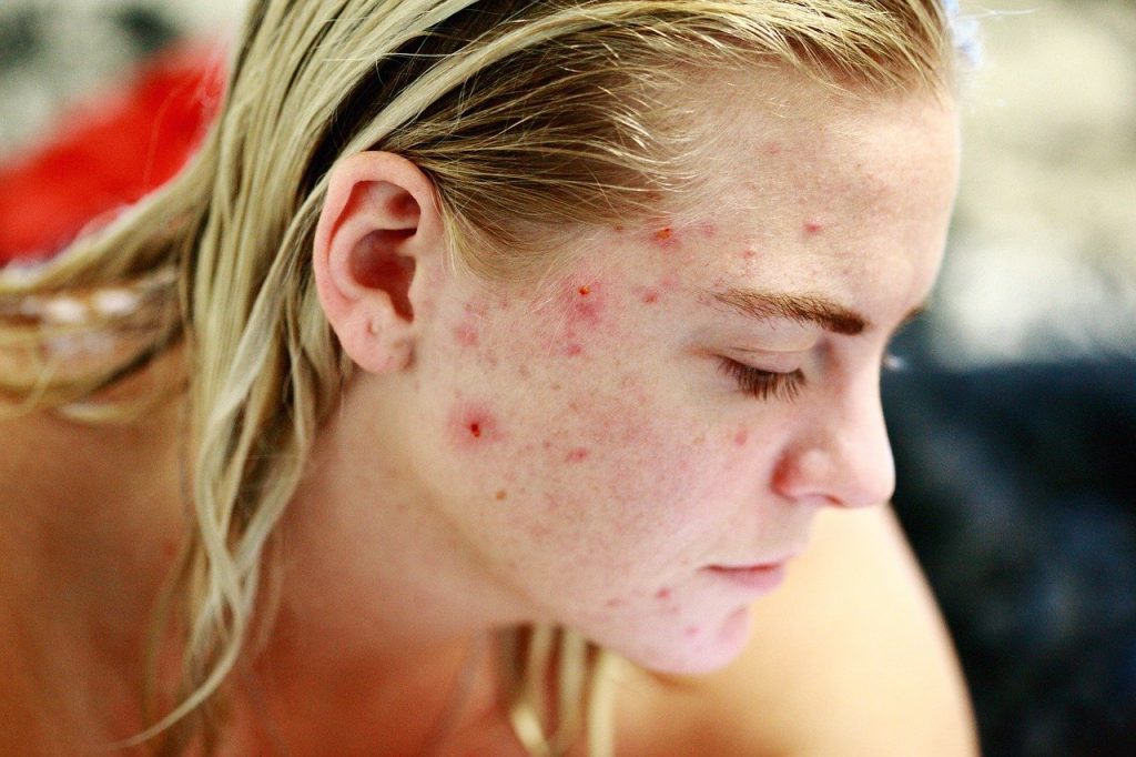 reconnaître la dermatite négligée